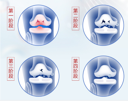 吃氨糖软骨素要吃多久？原来如此！