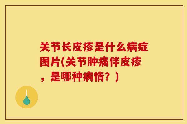 关节长皮疹是什么病症图片(关节肿痛伴皮疹，是哪种病情？)