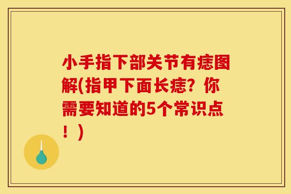 小手指下部关节有痣图解(指甲下面长痣？你需要知道的5个常识点！)